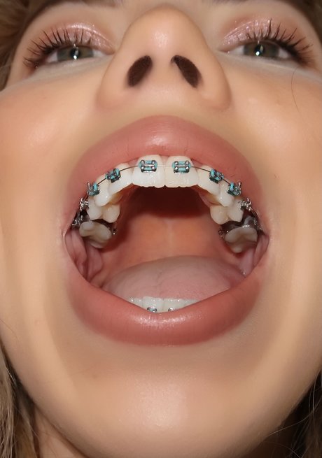Kate in Braces leaked onlyfans.
